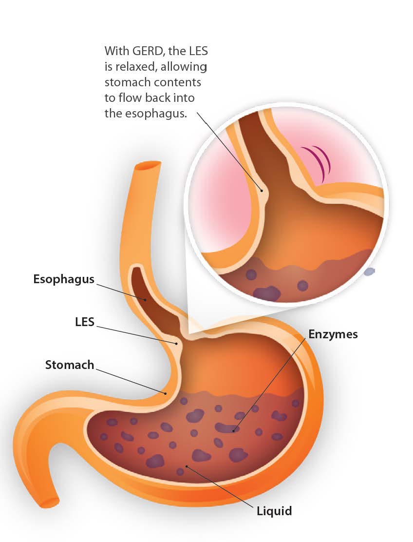 Gerd, PPI long term side effects